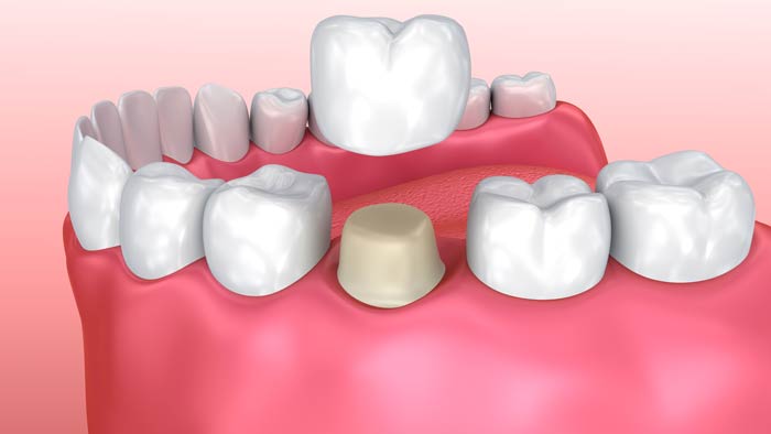 Dental Crowns Wyoming Dentist